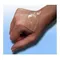 Immagine 1 Per Cica-Care Gel In Silicone Per Il Trattamento Delle Cicatrici 12cmx15cm 1 Medicazione
